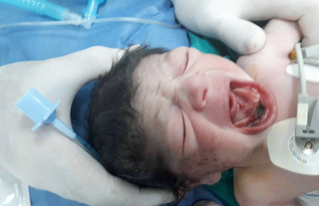جراحة نادرة لطفل حديث الولادة بمستشفى مدينة نصر للتأمين الصحي