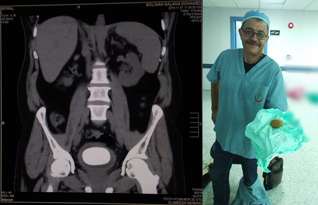 استخراج حصوة كبيرة من مثانة مريض بمستشفى العريش العام