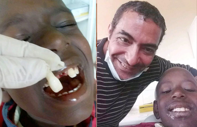 طبيب مصري ينجح في إجراء زرع سنة وعمل عصب كامل خارج الفم لطفل في بوروندي |صور
