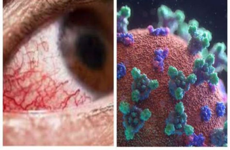 خبير فيروسات يكشف ما هو مرض الفطر الأسود وأسباب الإصابة به |فيديو - بوابة  الأهرام