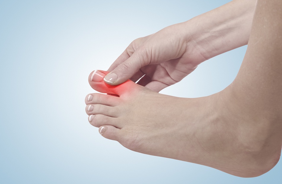 Causes and treatment of gout