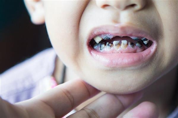 لماذا أصبحت أسنان أطفال الجيل الحالي أكثر عرضة للتسوس؟