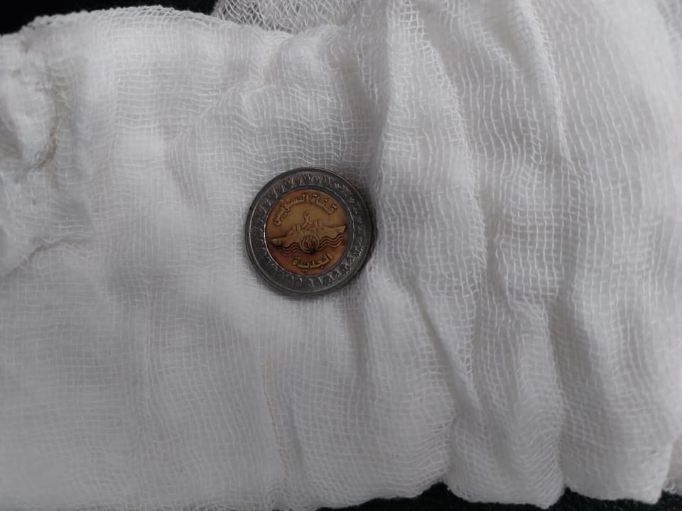 استخراج عُملة معدنية من طفلة في مستشفى دكرنس