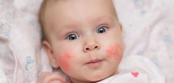 ما هي أعراض إصابة طفلك بـ حساسية البيض؟