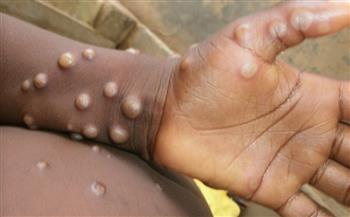 بعد ظهوره كحماية من مرض القرود حكاية تطعيمات وباء الجدري في مصر | صور