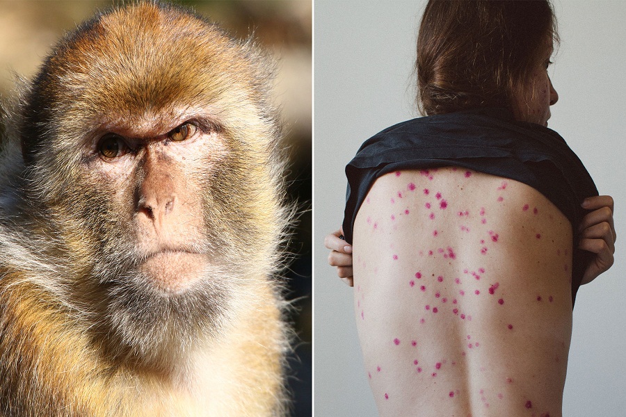;الصحة; تعلن عن أول حالة إصابة بفيروس جدري القردة في مصر