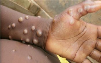   وكالة إفريقية تحذر من تخزين اللقاحات في ظل انتشار إصابات جدري القرود