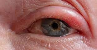   التهاب-جلد-جفن-العين-الأسباب-وطرق-الوقاية-والعلاج