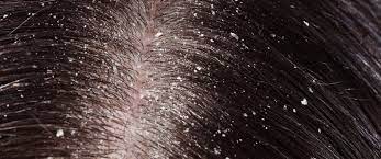 تعانى من قشرة الشعر في فصل الشتاء .. إليك الأسباب والأعراض و6 علاجات منزلية  - بوابة الأهرام